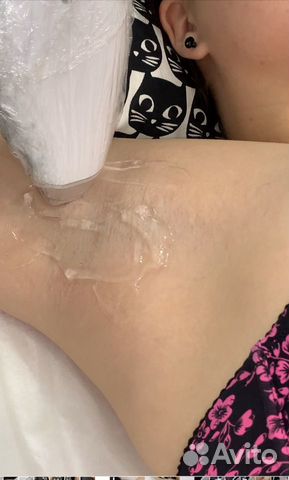 Лазерная эпиляция Лазерная эпиляция